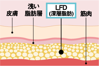 皮膚 浅い脂肪層 LFD(深層脂肪) 筋肉