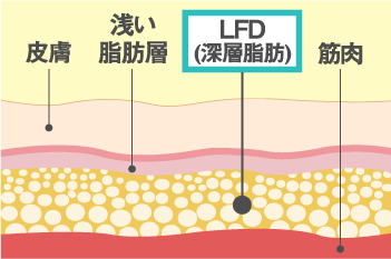 LFD脂肪注入法
